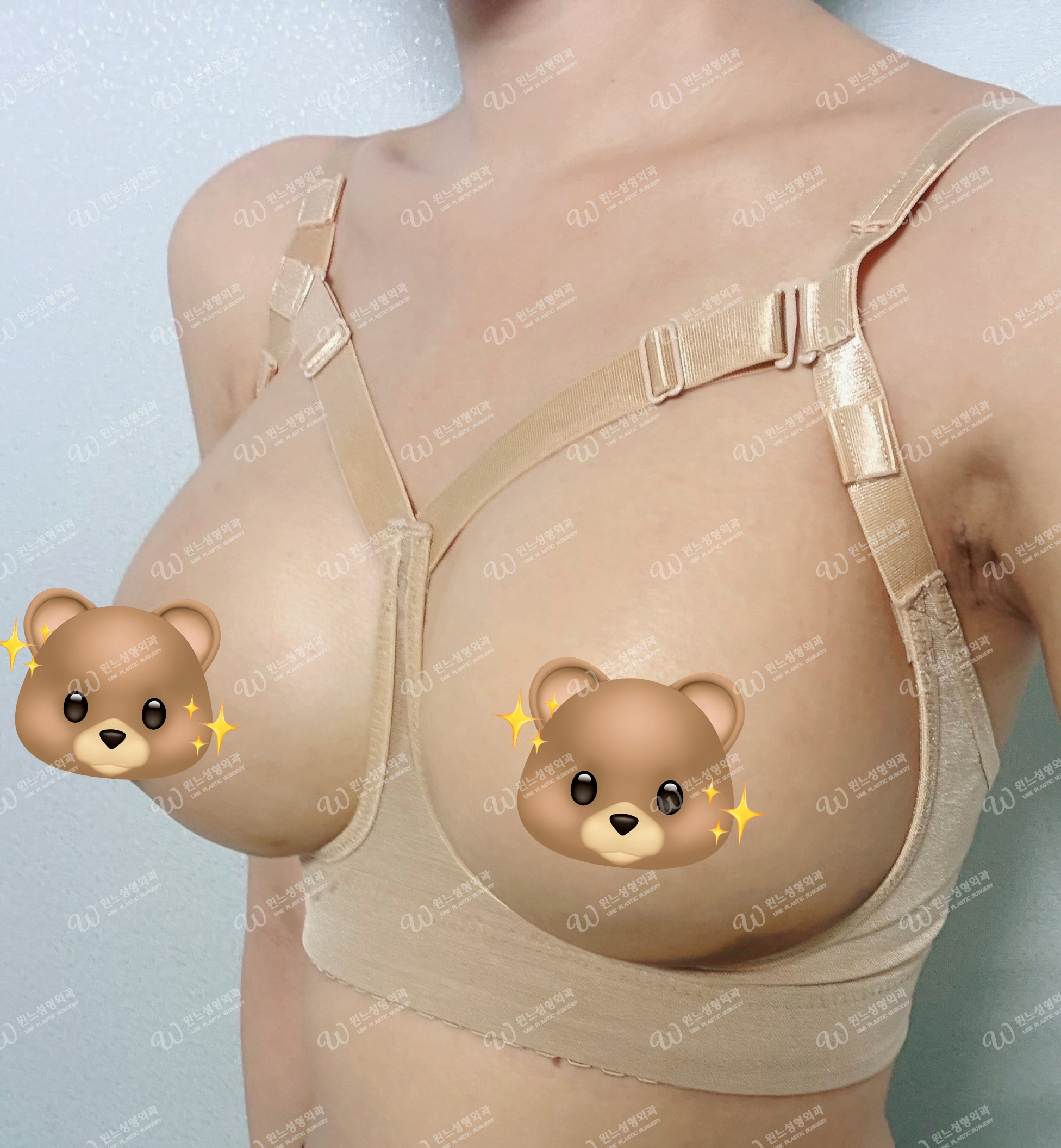 멘토엑스트라 325 350cc 가슴성형 1주차 후기 | 윈느 성형외과 김의건 원장님