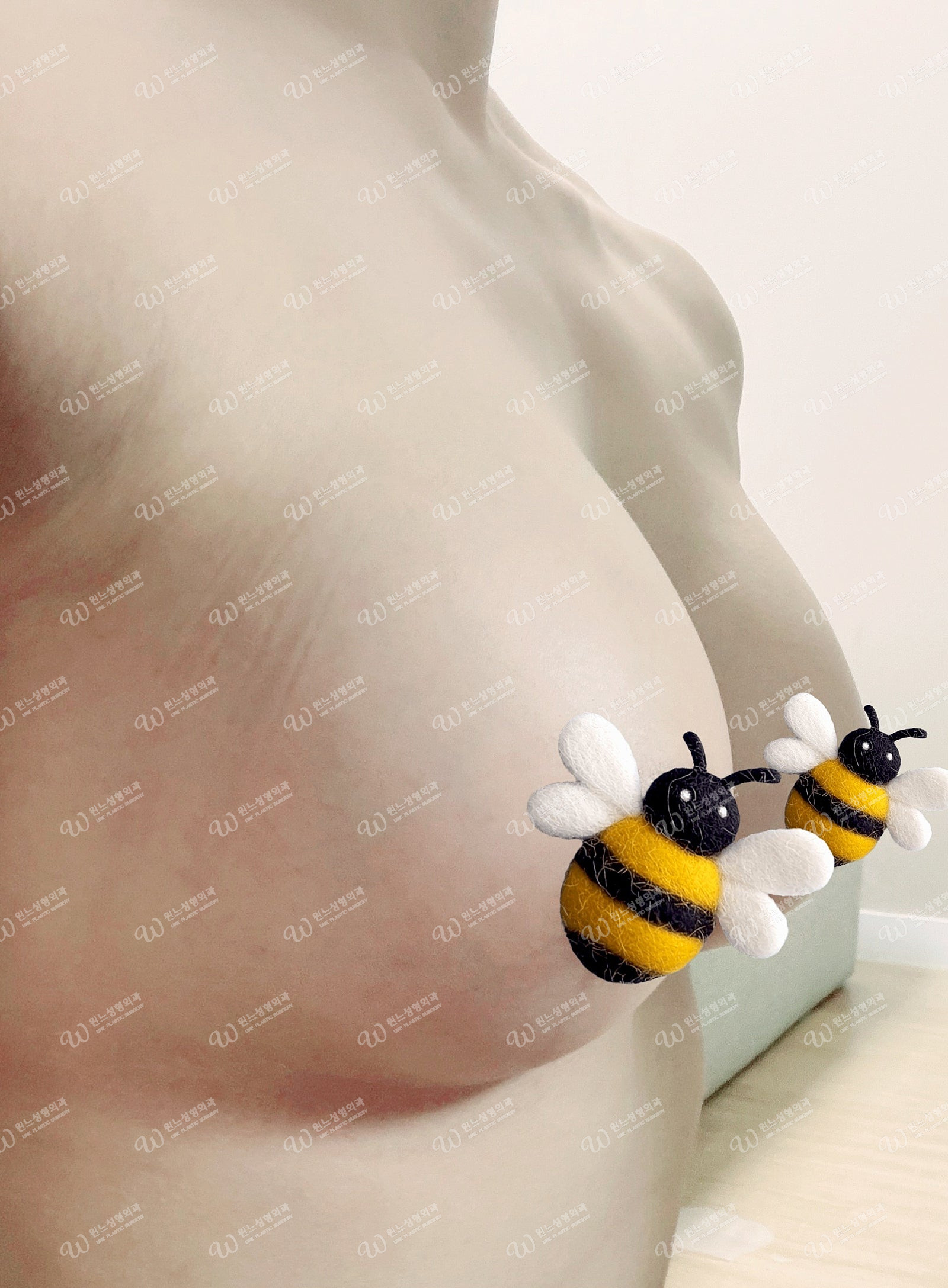 멘토엑스트라 325cc 수술후 2개월차 가슴 멘토엑스트라 325cc 수술후 2개월차 가슴