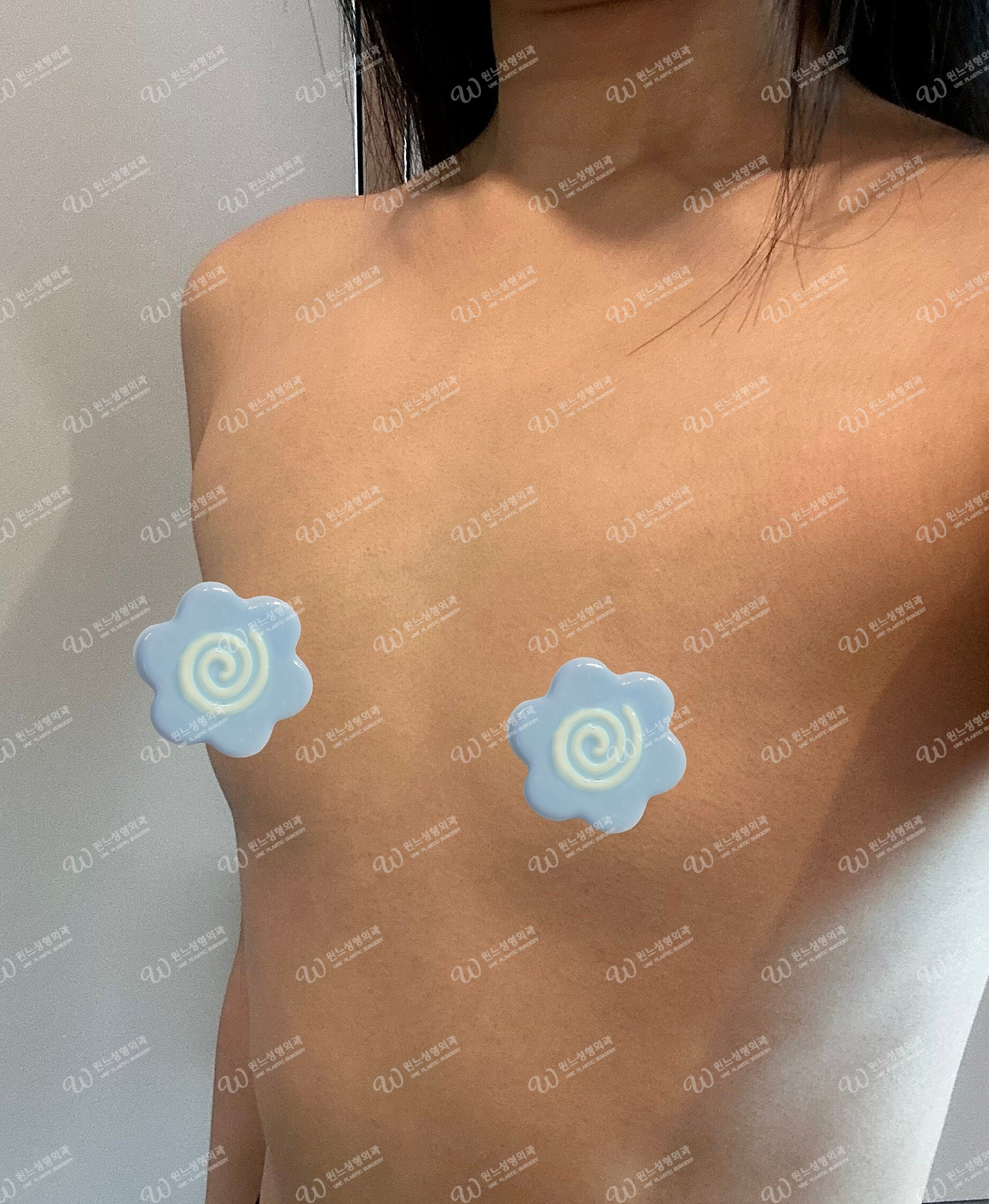 멘토 엑스트라 겨드랑이 절개 6개월 경과