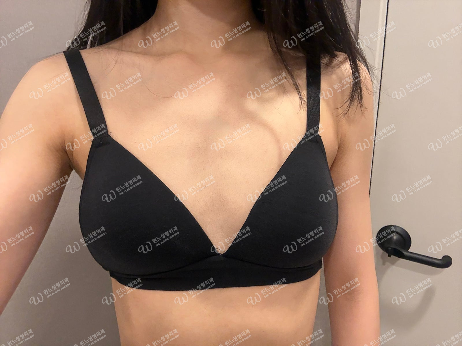 Motiva 285cc แผลใต้รักแร้ ผลลัพธ์หลังผ่าตัด 1 เดือน Motiva 285cc แผลใต้รักแร้ ผลลัพธ์หลังผ่าตัด 1 เดือน