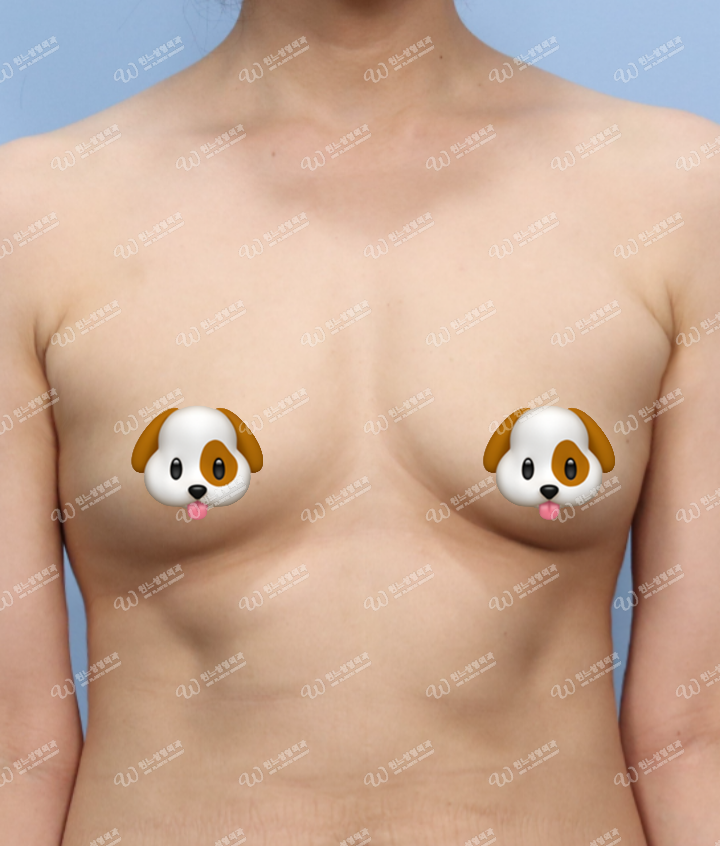 가슴성형 수술 전 모습 가슴성형 수술 전 모습