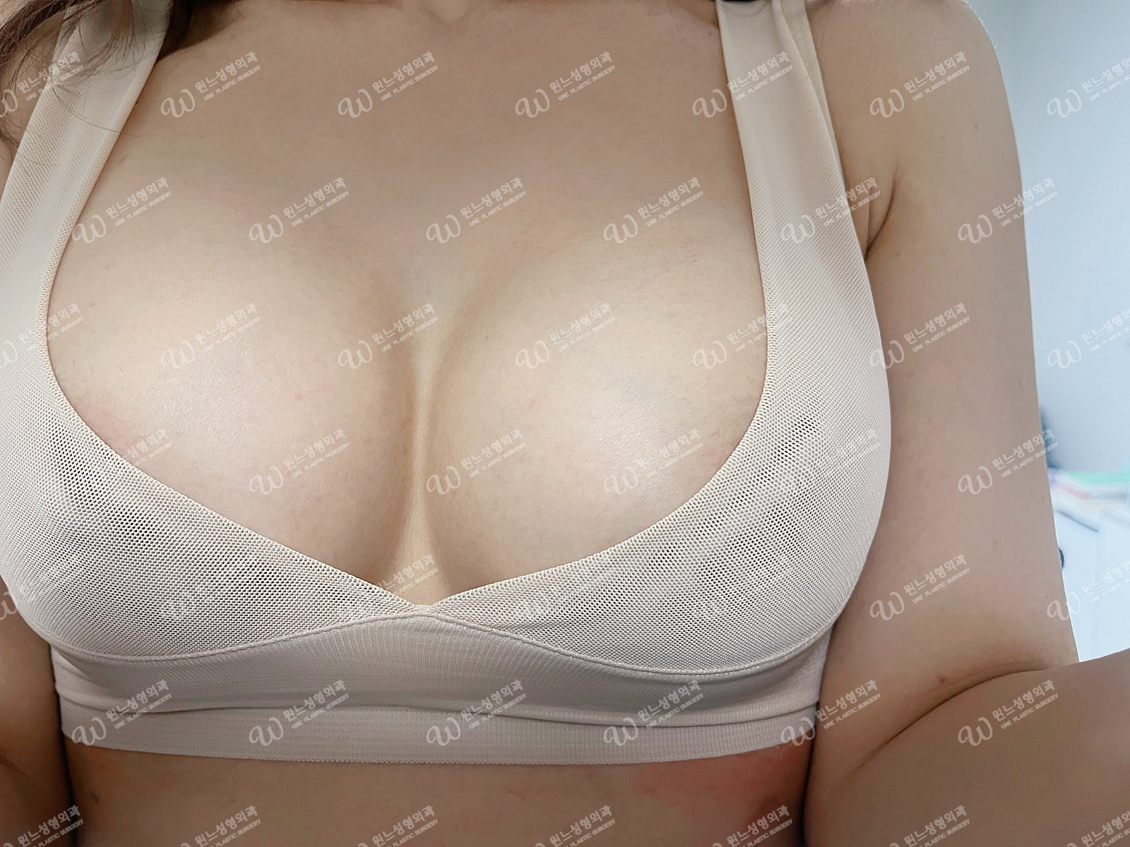 모티바 320cc 수술 후 달라진 태