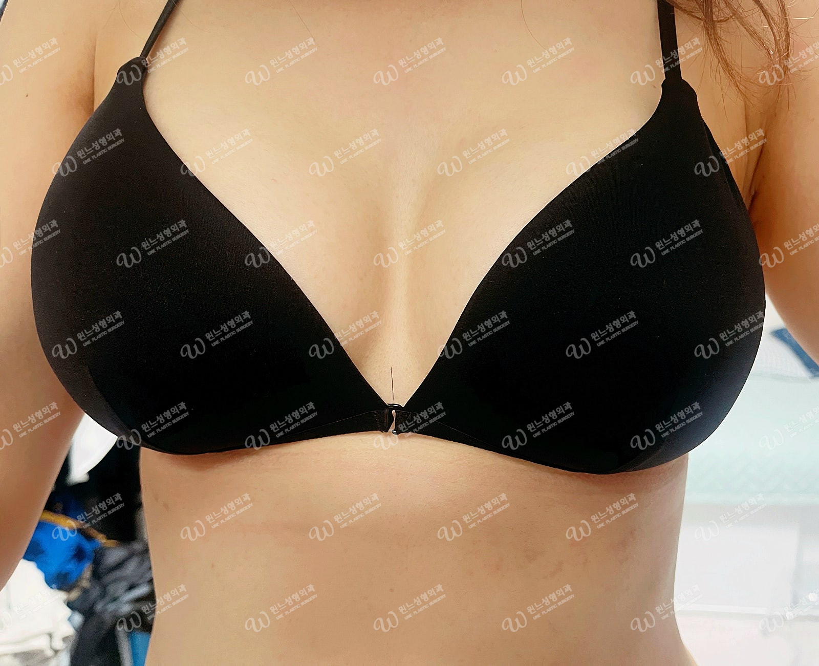 모티바320cc 삽입 후 3개월차 모습 모티바320cc 삽입 후 3개월차 모습