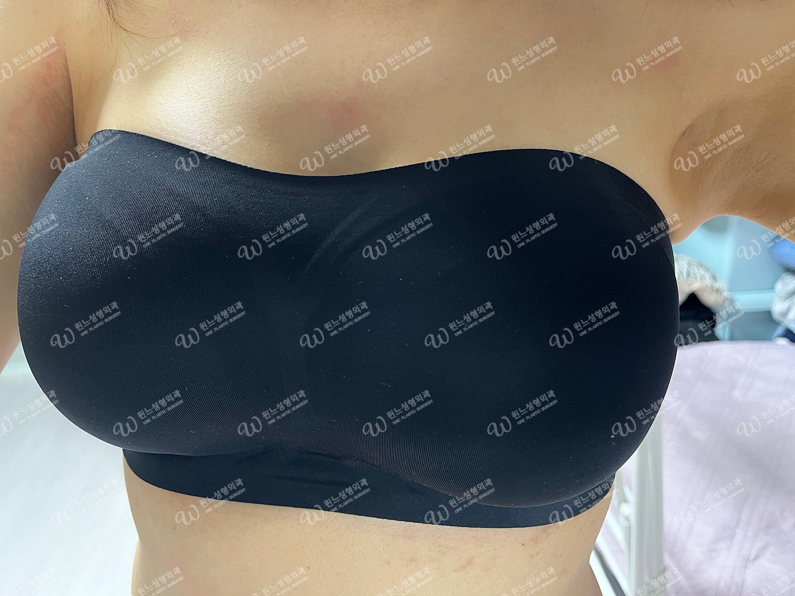 모티바 320cc 가슴확대 2달차 후 모습 모티바 320cc 가슴확대 2달차 후 모습