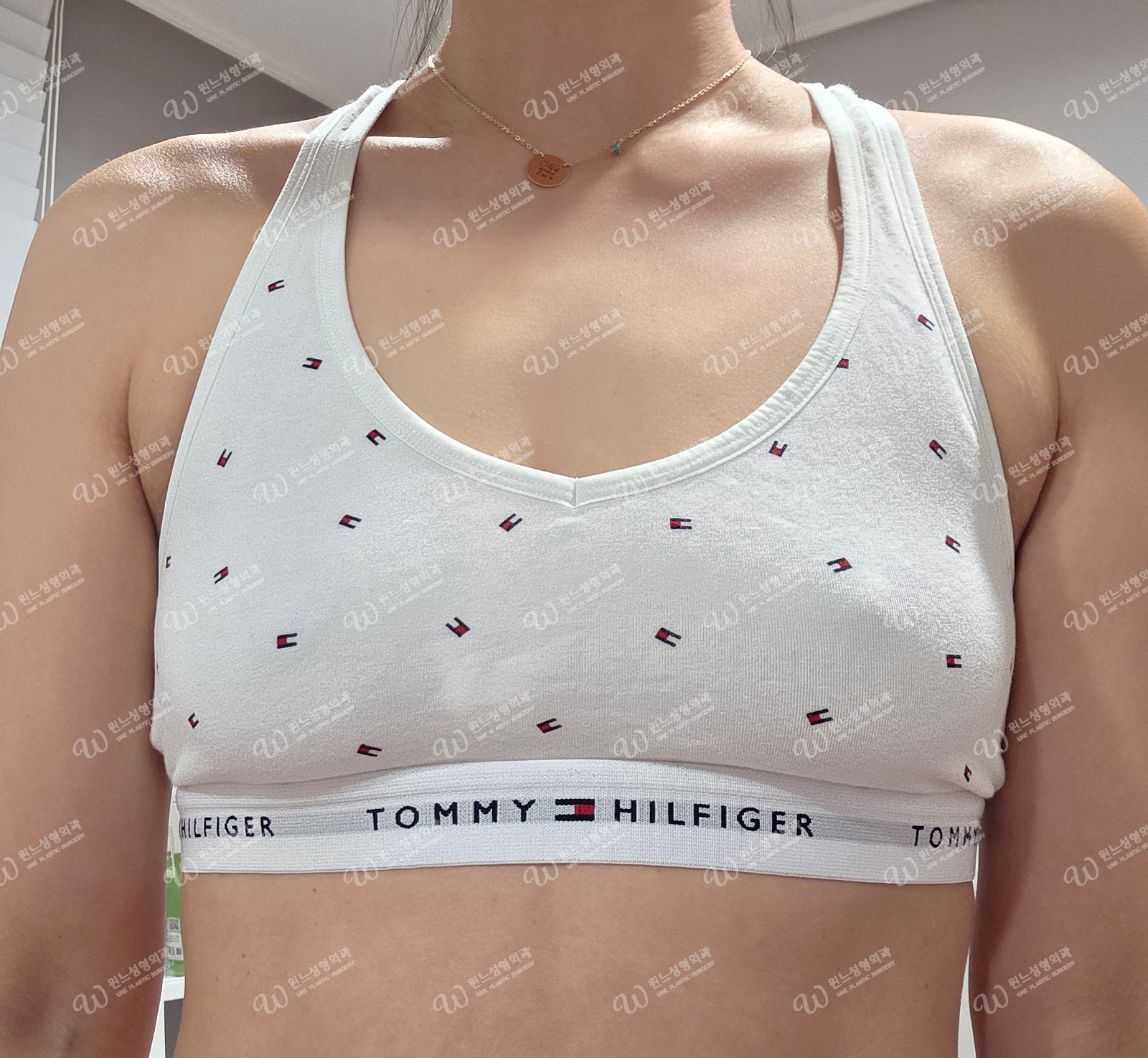 모티바 340cc 320cc 삽입 후 가슴 모습 모티바 340cc 320cc 삽입 후 가슴 모습