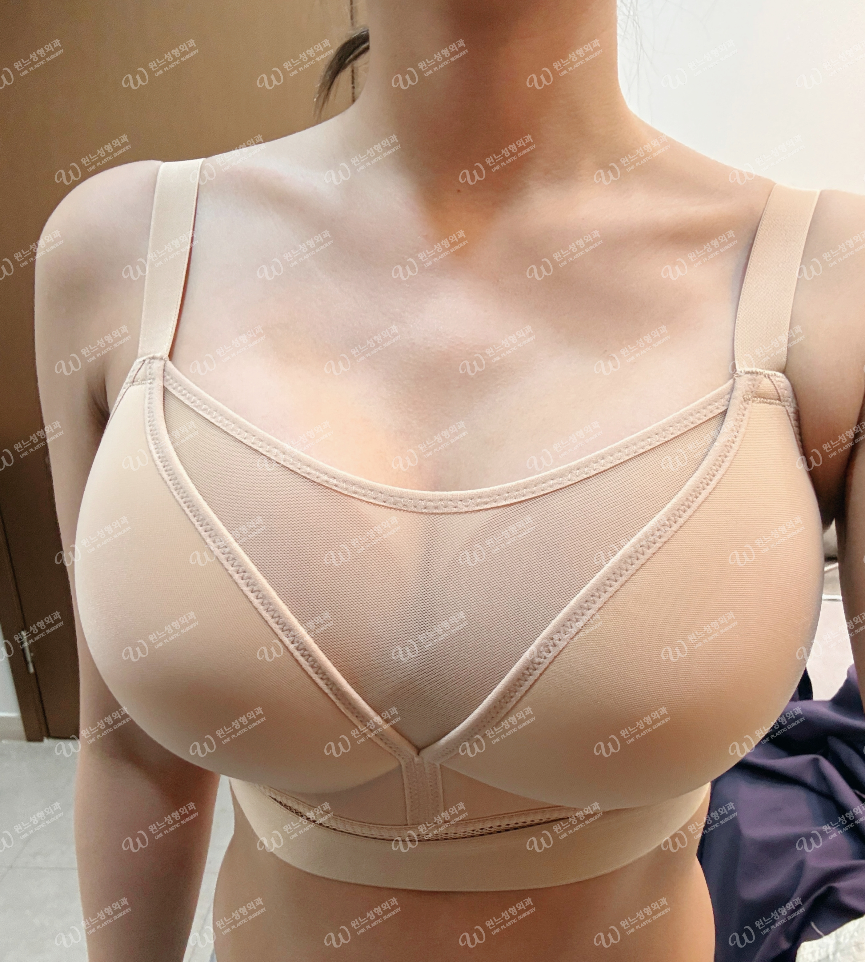 모티바 근막하 겨절 수술 1달차 모양 모티바 근막하 겨절 수술 1달차 모양
