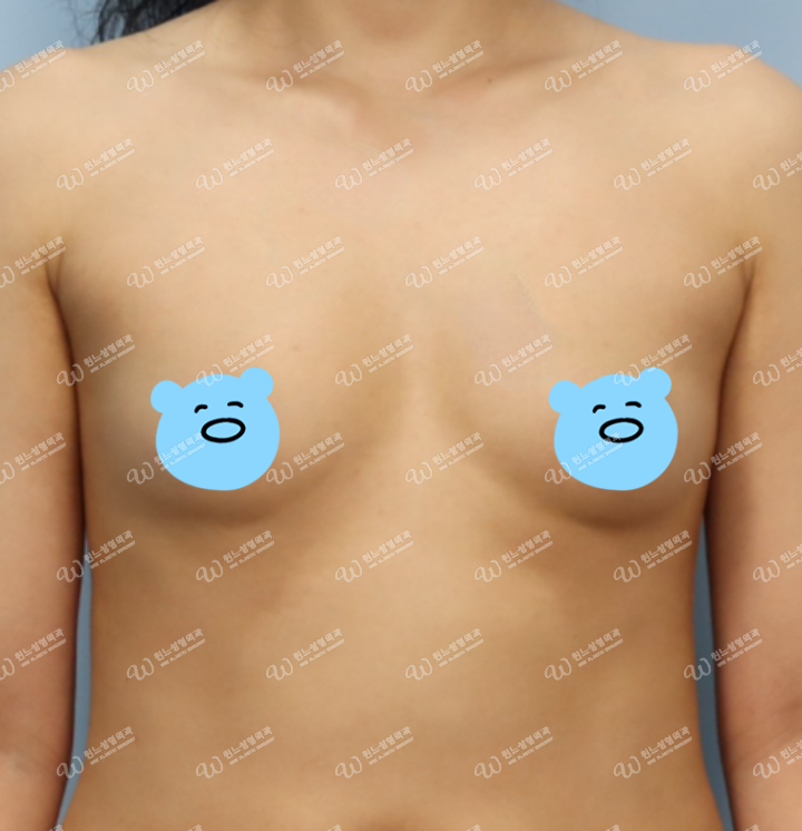모티바 미니 겨드랑이 절개 2개월차 후기