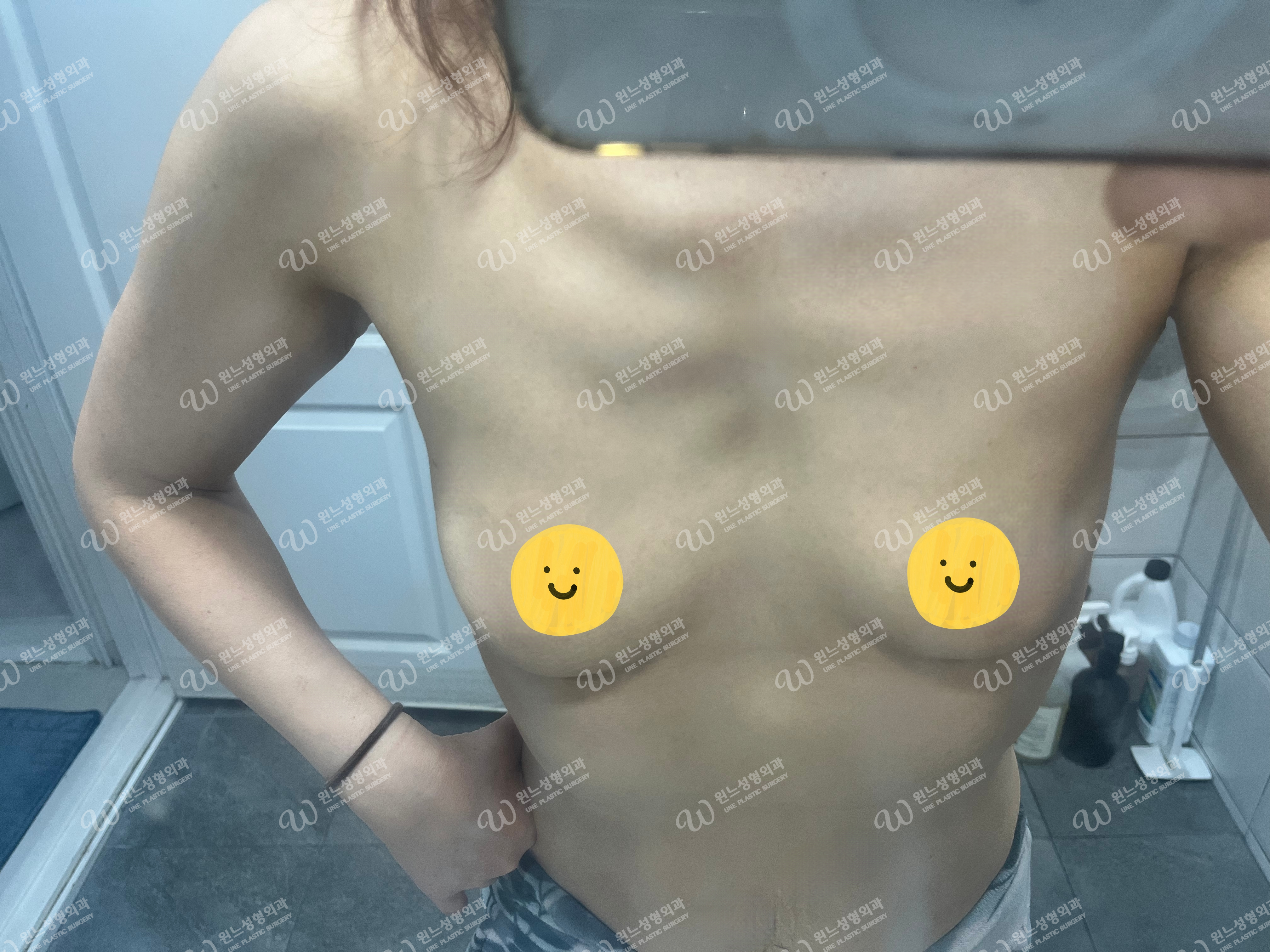 모티바 가슴성형 후 볼륨감 있는 가슴