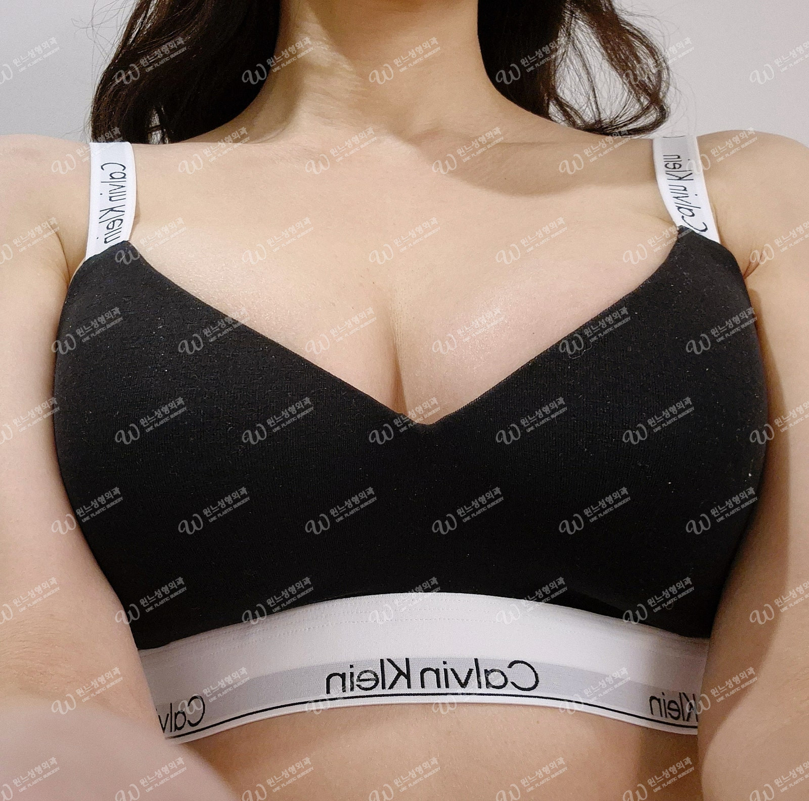 가슴성형 수술 후 자연스러운 모양 가슴성형 수술 후 자연스러운 모양