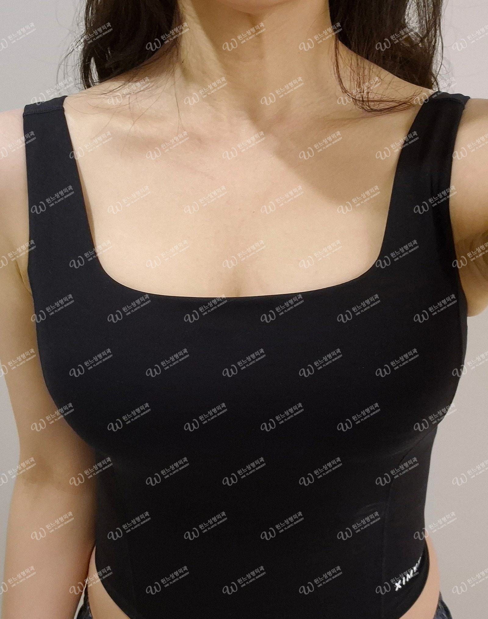 가슴성형 수술 후 자연스러운 모양 가슴성형 수술 후 자연스러운 모양