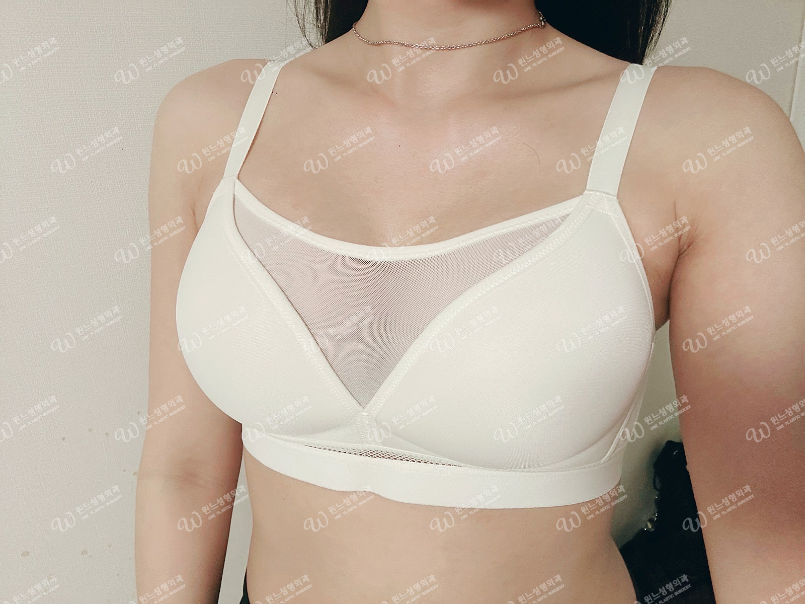 Motiva Mini รูปทรงหน้าอกที่เป็นธรรมชาติ หลังผ่าตัด 1 เดือน Motiva Mini รูปทรงหน้าอกที่เป็นธรรมชาติ หลังผ่าตัด 1 เดือน