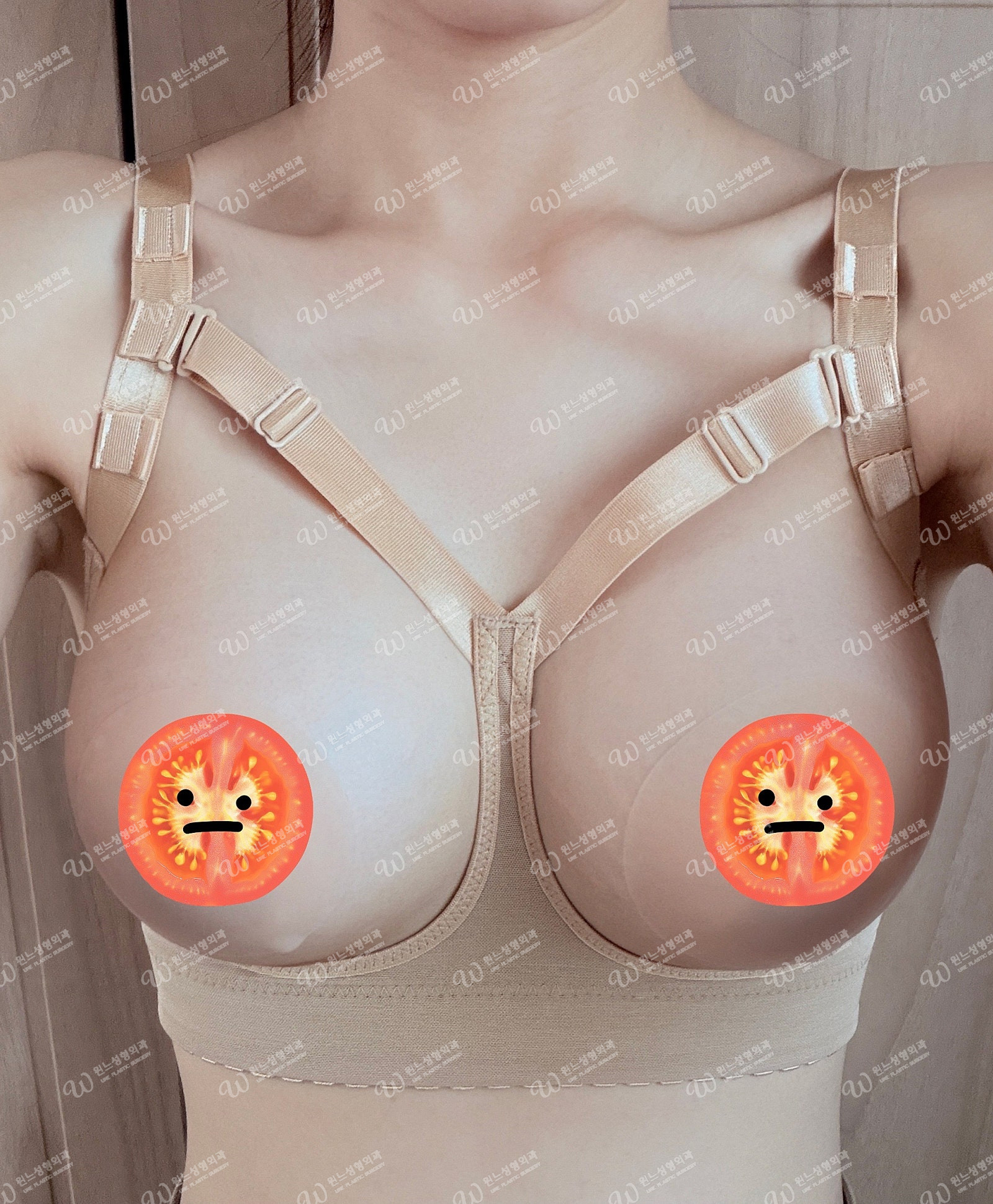 가슴수술후기 - 166cm 50kg 밑절 멘토엑스트라 325·350cc 가슴수술 1주차 후기 | 윈느 성형외과 김의건 원장님 대표 사진