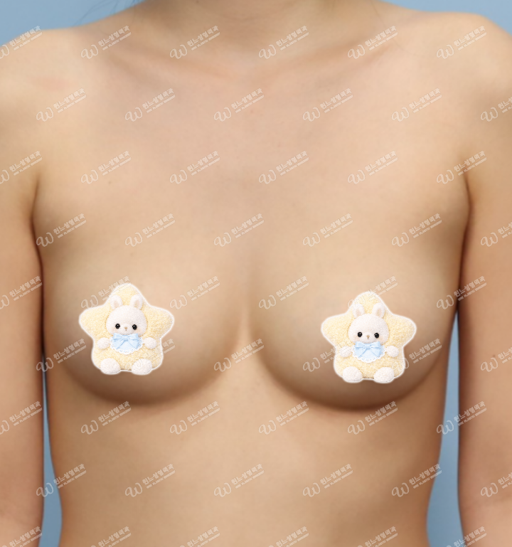 ภาพก่อนเสริมหน้าอกที่ UNE Plastic Surgery