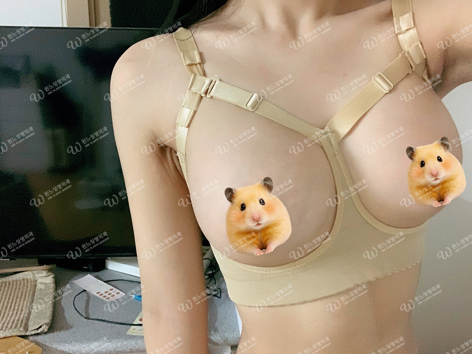 ผลลัพธ์ระดับ Full C 1 เดือนหลังเสริมหน้าอกที่ UNE Plastic Surgery