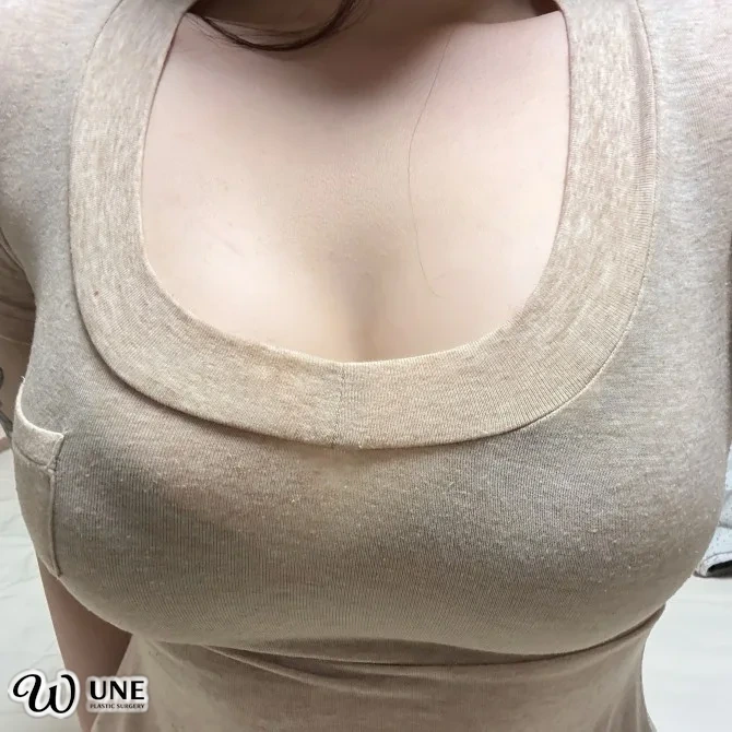 윈느성형외과 가슴성형 리얼셀피 #043