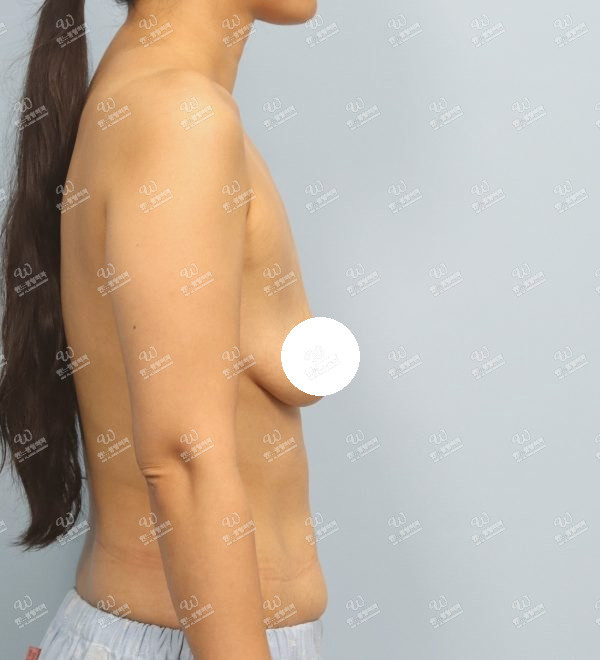 처짐과 볼륨 부족을 교정한 가슴확대술 전 측면 사진 모티바 케이스 58