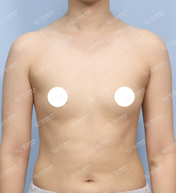 볼륨 부족을 교정한 가슴확대술 전 정면 사진 모티바 케이스 59
