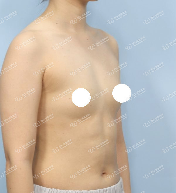 볼륨 부족을 교정한 가슴확대술 전 45도 사진 모티바 케이스 59