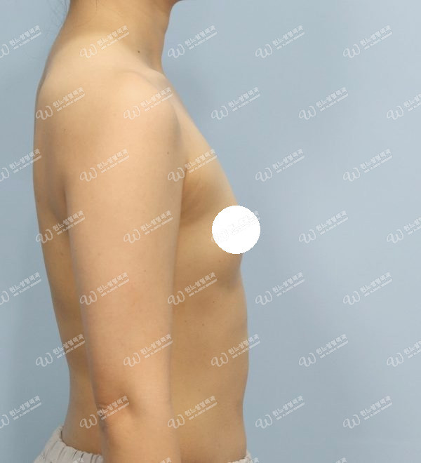 볼륨 부족을 교정한 가슴확대술 전 측면 사진 모티바 케이스 59