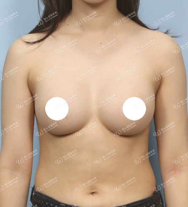 볼륨 부족을 교정한 가슴확대술 후 3개월 정면 사진 모티바 케이스 59