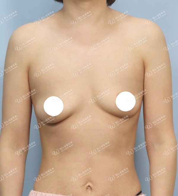 볼륨 부족과 꺼진가슴을 교정한 가슴확대술 전 정면 사진 모티바 케이스 60