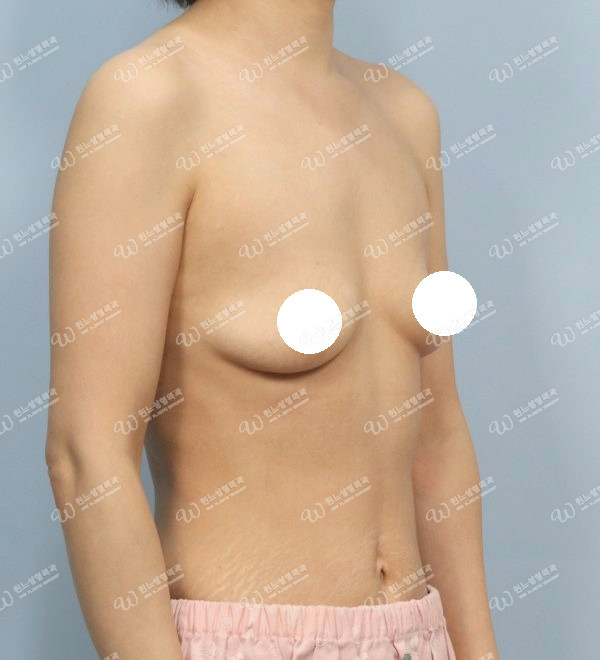 볼륨 부족과 꺼진가슴을 교정한 가슴확대술 전 45도 사진 모티바 케이스 60