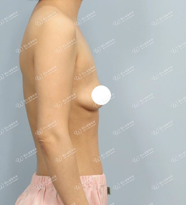 볼륨 부족과 꺼진가슴을 교정한 가슴확대술 전 측면 사진 모티바 케이스 60