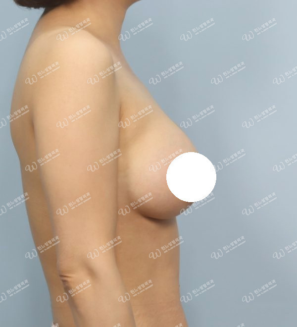 볼륨 부족과 꺼진가슴을 교정한 가슴확대술 후 2개월 측면 사진 모티바 케이스 60