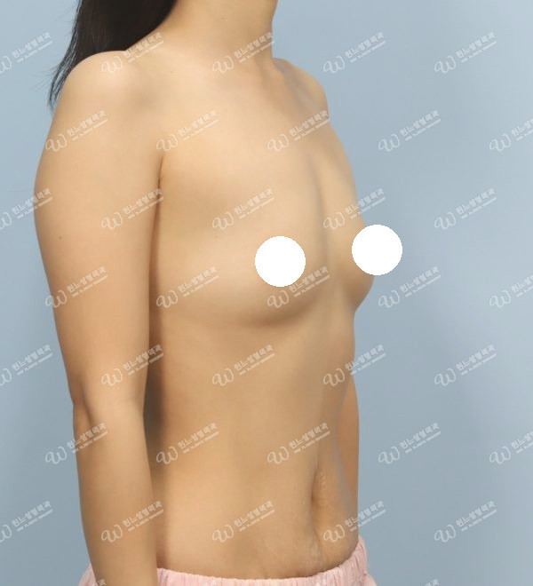 볼륨 부족을 교정한 가슴확대술 전 45도 사진 멘토 엑스트라 케이스 61