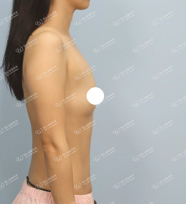 볼륨 부족을 교정한 가슴확대술 전 측면 사진 멘토 엑스트라 케이스 61