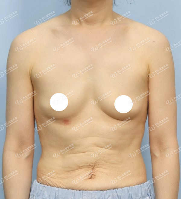 UNE Plastic Surgery similar breast surgery case before photo