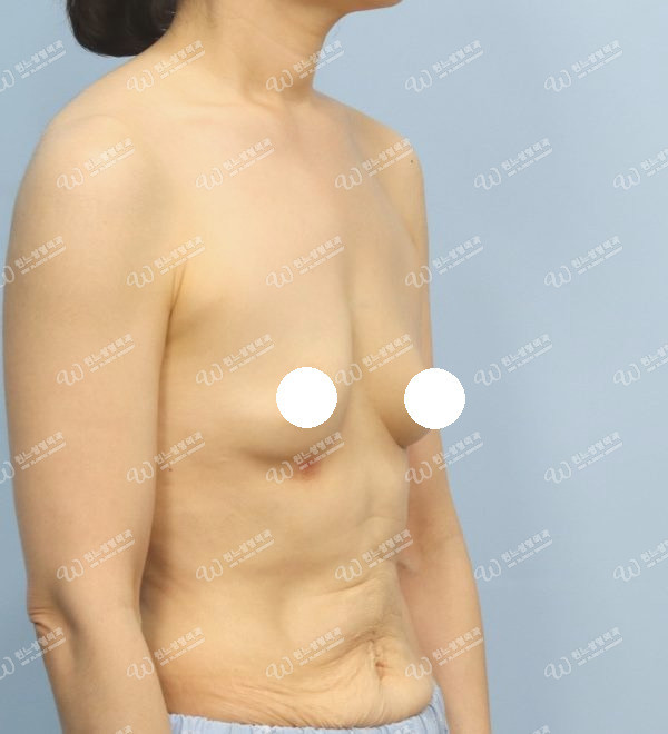 UNE 豊胸手術 術前 普通 50代以上 45度 症例 #85