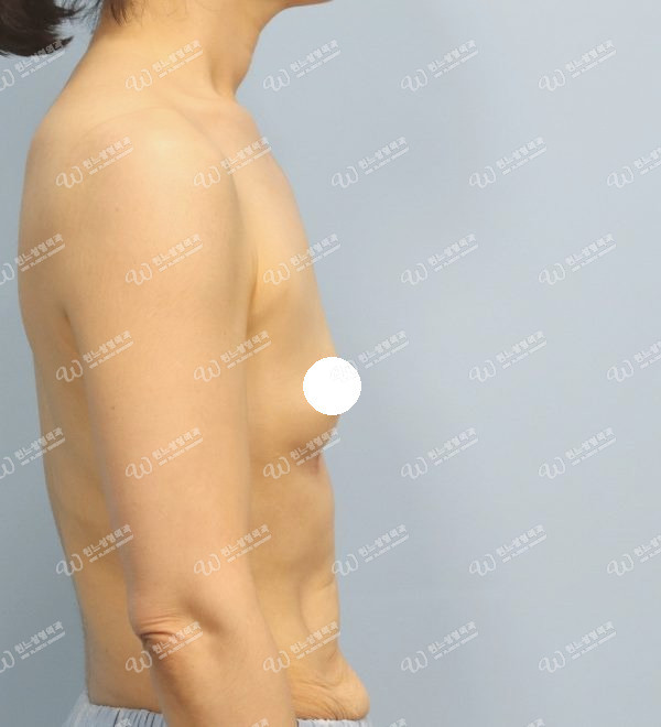 UNE 豊胸手術 術前 普通 50代以上 側面 症例 #85