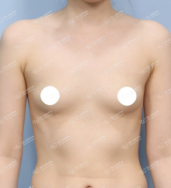 볼륨 부족을 교정한 가슴확대술 전 정면 사진 모티바 케이스 63