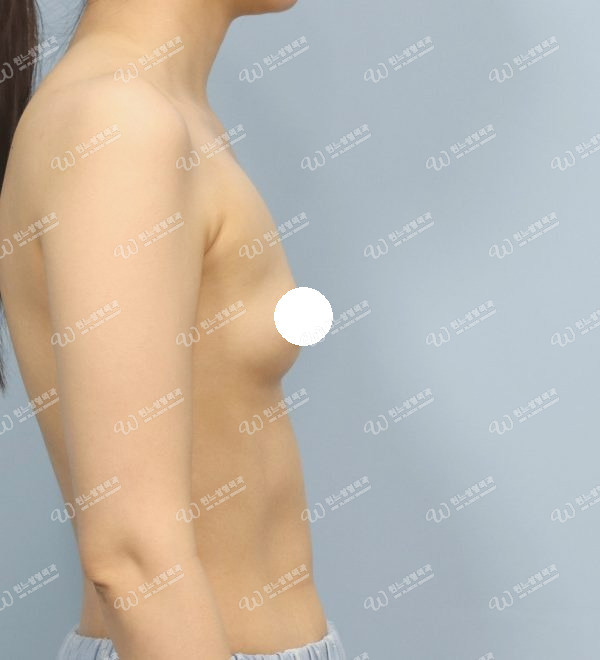 볼륨 부족을 교정한 가슴확대술 전 측면 사진 모티바 케이스 63