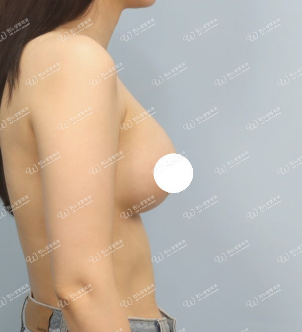 볼륨 부족을 교정한 가슴확대술 후 3개월 측면 사진 모티바 케이스 63