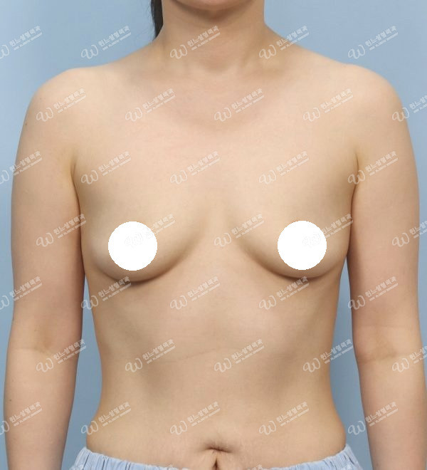 볼륨 부족을 교정한 가슴확대술 전 정면 사진 모티바