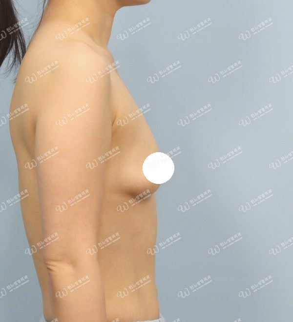 볼륨 부족을 교정한 가슴확대술 전 측면 사진 모티바 케이스 64
