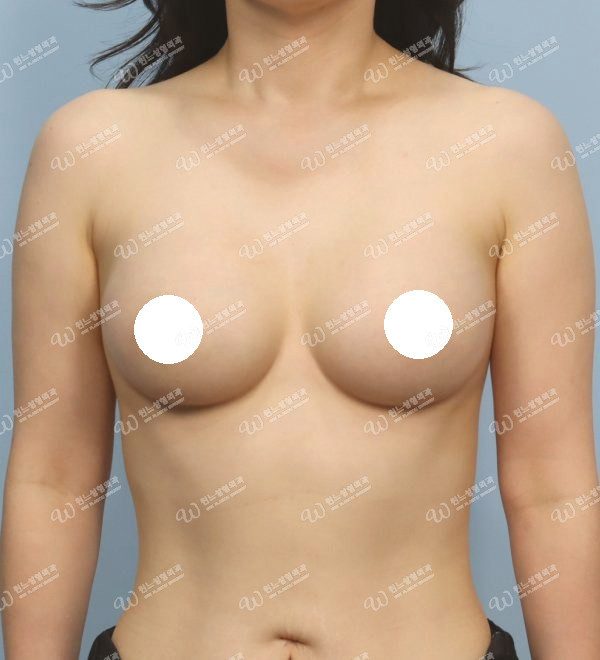 볼륨 부족을 교정한 가슴확대술 후 3개월 정면 사진 모티바 케이스 64