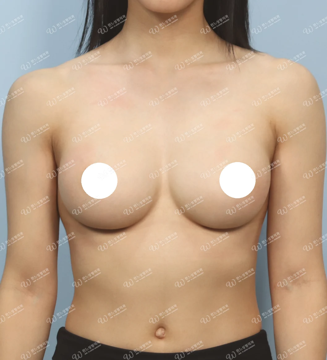 모양 불만족과 촉감 불만족을 교정한 가슴재수술 후 2개월 정면 사진 모티바 케이스 68