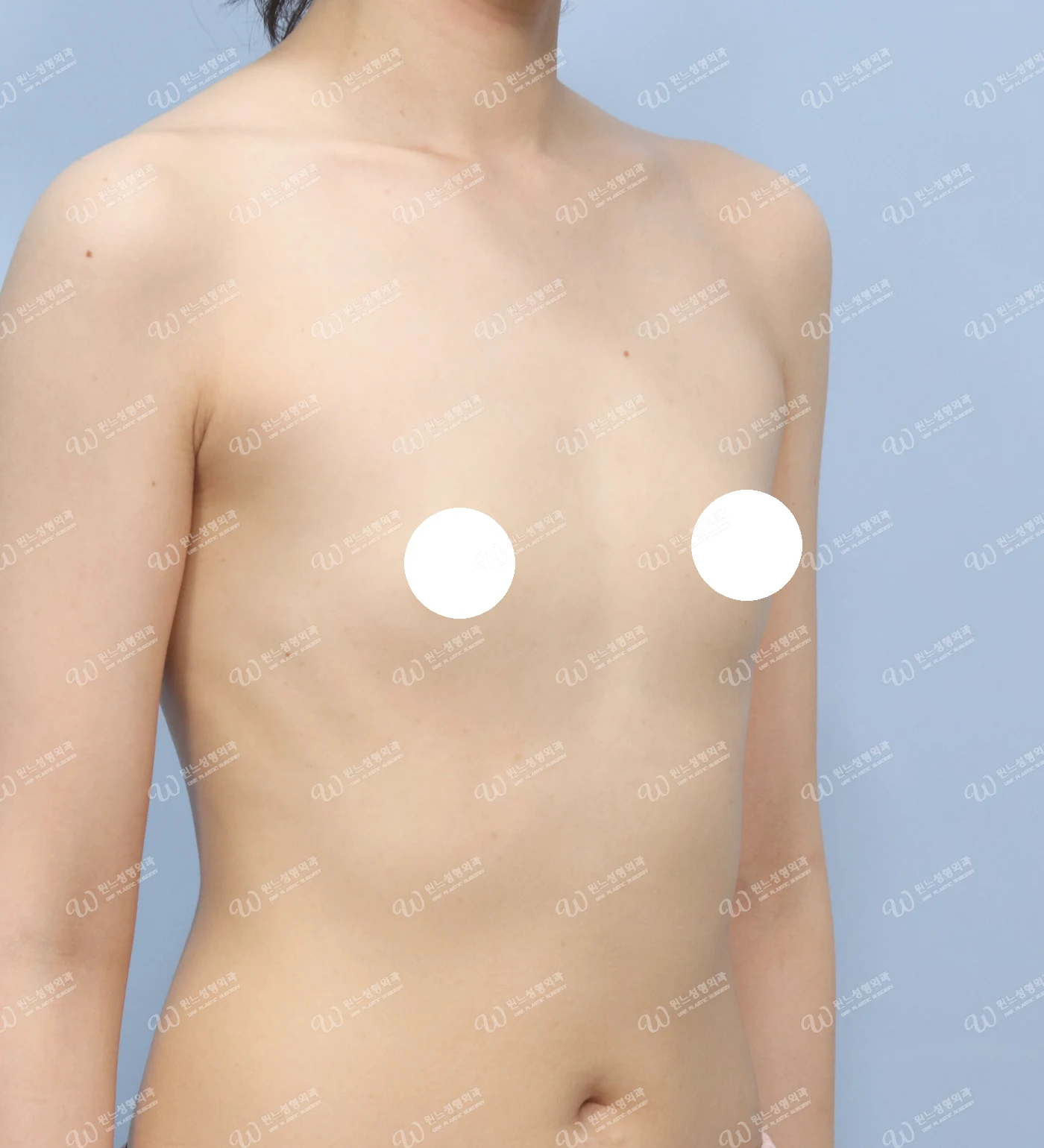 볼륨 부족을 교정한 가슴확대술 전 45도 사진 모티바 케이스 70