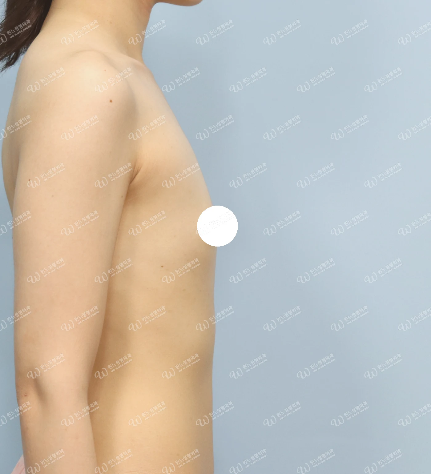 볼륨 부족을 교정한 가슴확대술 전 측면 사진 모티바 케이스 70