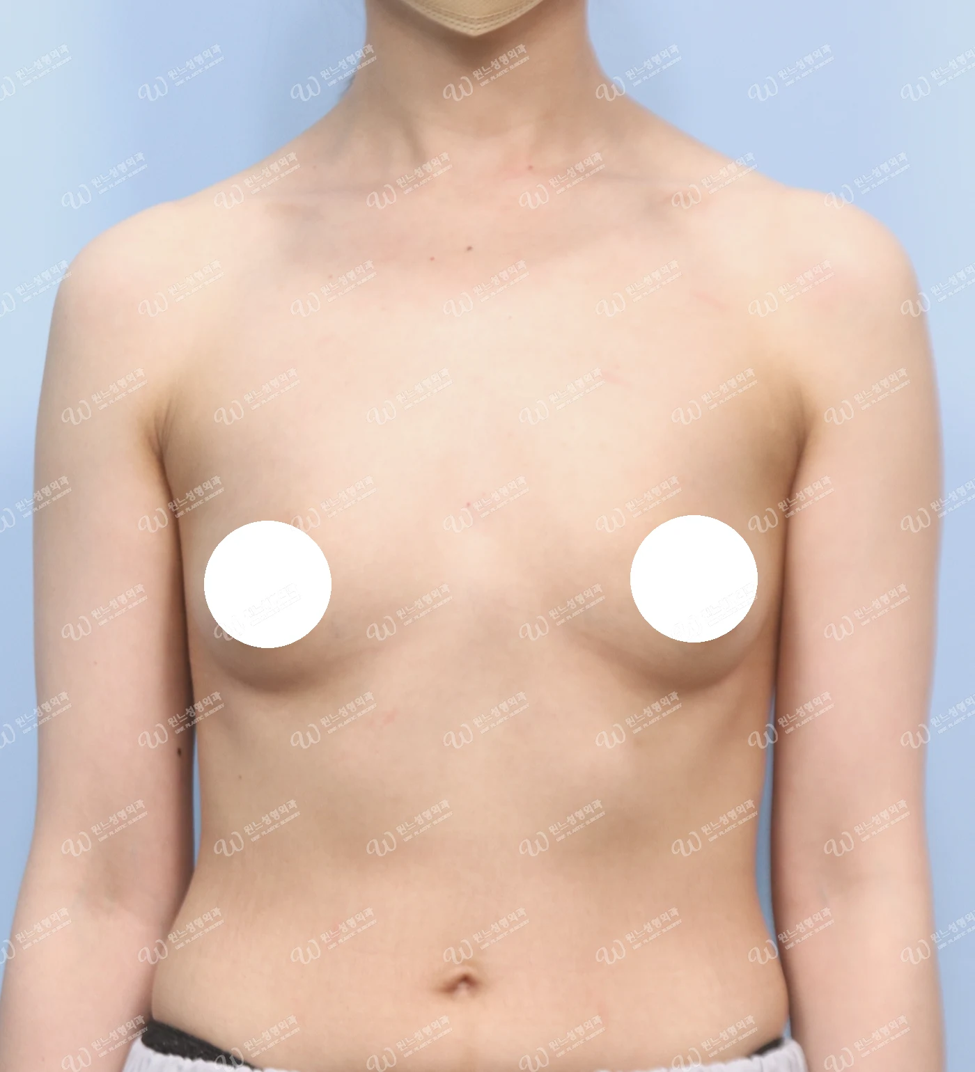 볼륨 부족과 심한 새가슴을 교정한 가슴확대술 전 정면 사진 모티바 케이스 71