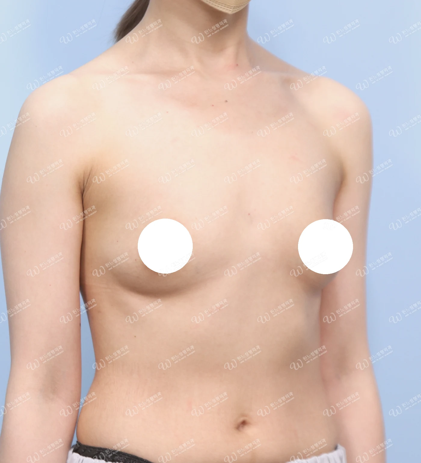 볼륨 부족과 심한 새가슴을 교정한 가슴확대술 전 45도 사진 모티바 케이스 71