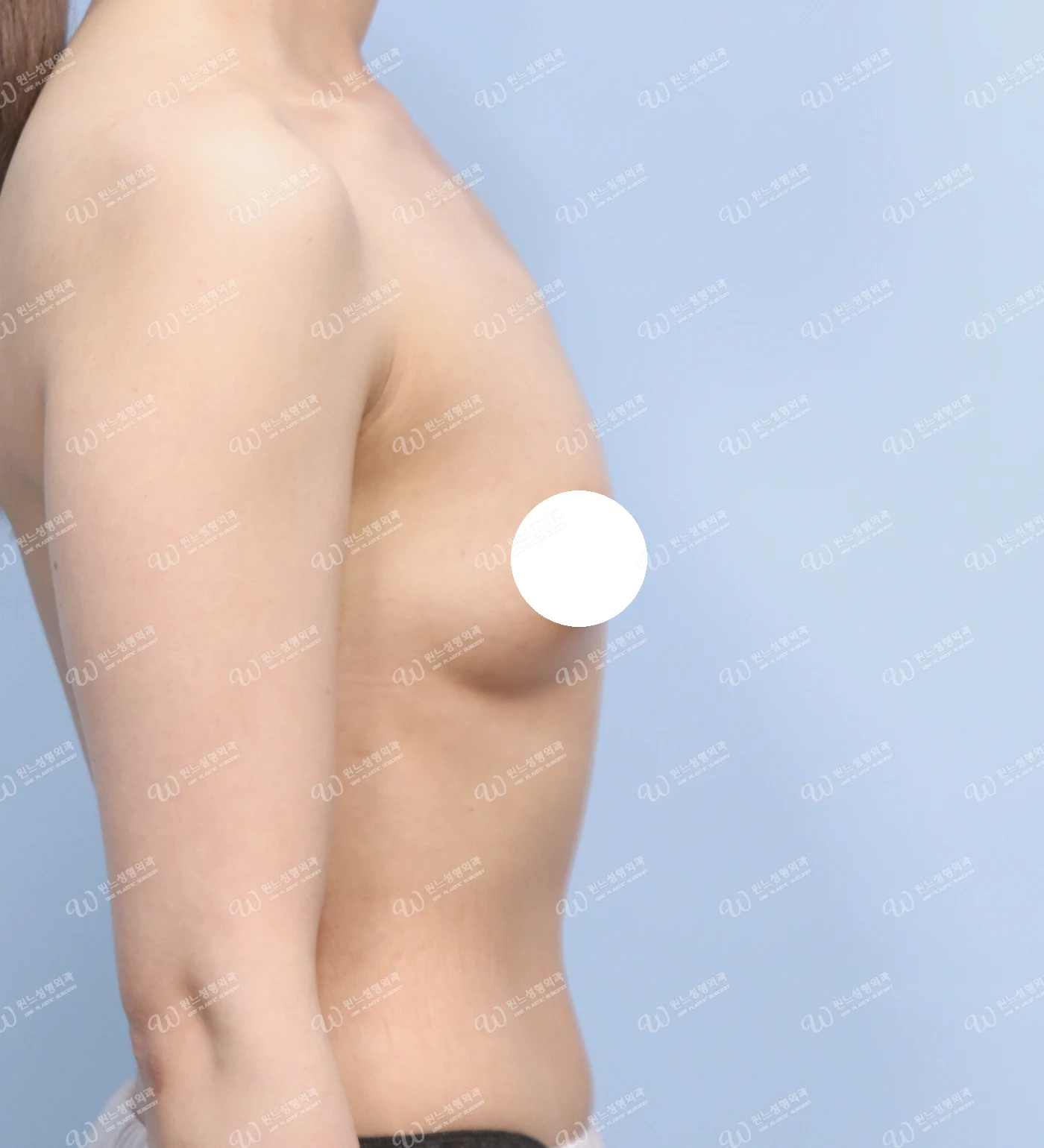 볼륨 부족과 심한 새가슴을 교정한 가슴확대술 전 측면 사진 모티바 케이스 71