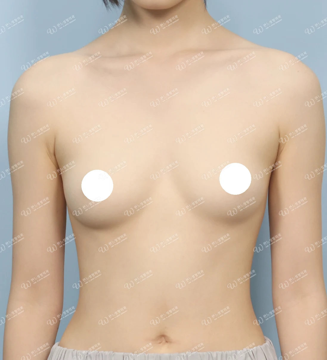 볼륨 부족을 교정한 가슴확대술 전 정면 사진 멘토 엑스트라 케이스 72