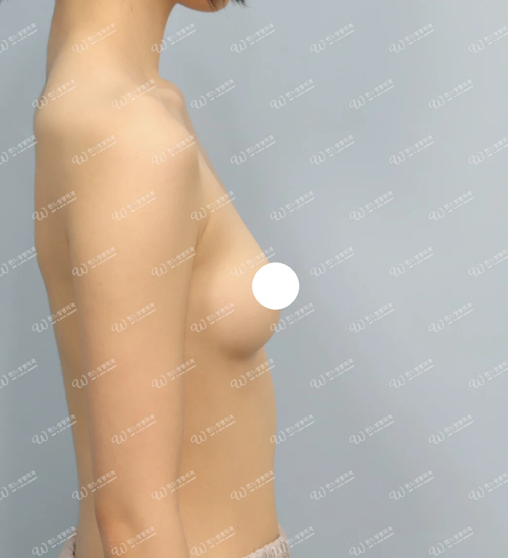 볼륨 부족을 교정한 가슴확대술 전 측면 사진 멘토 엑스트라 케이스 72