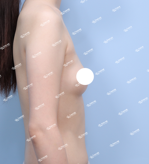 UNE 豊胸手術 術前 ぽっちゃり 30代 側面 症例 #15