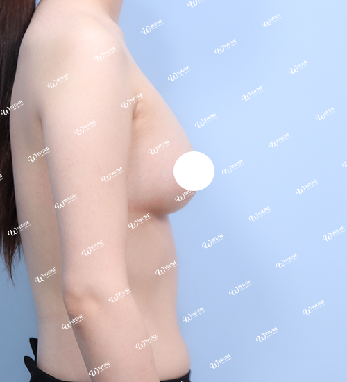 UNE 豊胸手術 術後 3ヶ月 モティバ 360cc ぽっちゃり 30代 側面 症例 #15