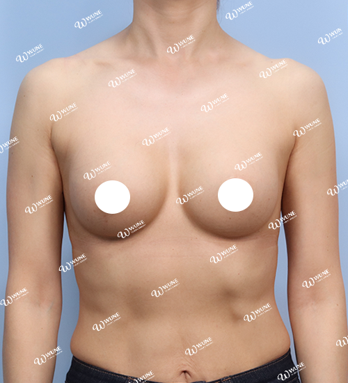 UNE Plastic Surgery breast surgery after - Front